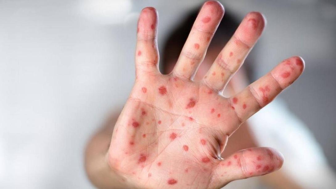 Affenpocken erhält einen neuen Namen: Mpox Affenpocken erhält einen neuen Namen: Mpox